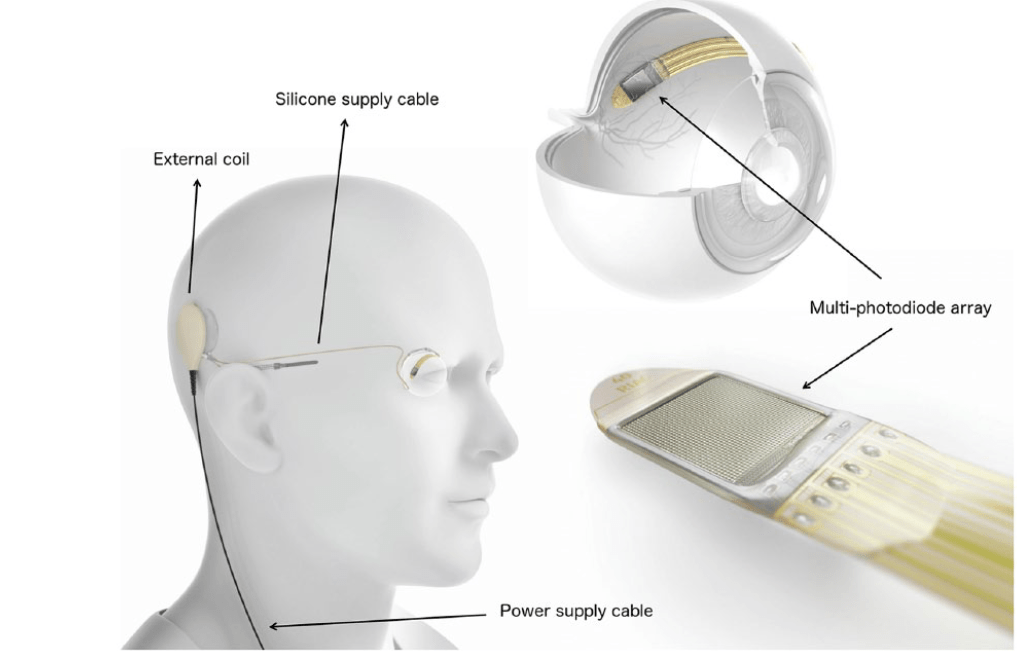 Subretinales Implantat